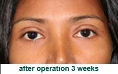 plastic-surgery-blepharoplasty